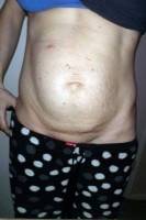 Abdominoplasty tummy tuck procedure