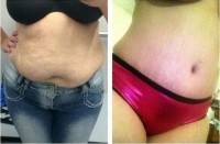 Abdominoplasty what to expect