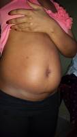 Abdominoplasty with c-section delivery