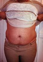 Abdominoplasty with rectus plication picture