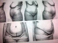 Abdominoplasty with rectus plication pictures