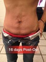 After floating tummy tuck