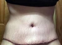 Age for plastic surgery of belly