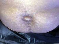 Age limit for plastic surgery belly button