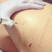 Alternatives to a tummy tuck mesotherapy needle