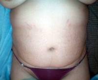 Before abdominoplasty with rectus plication