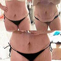 Before and after tummy tuck without muscle repair recovery