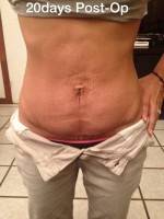 Belly button floating tummy tuck