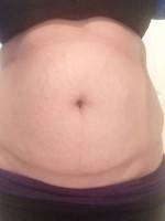 Belly tummy tuck photo