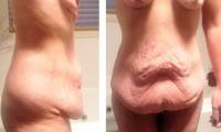 Can a tummy tuck operation remove stretch marks