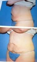 Can a tummy tuck surgery remove stretch marks