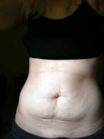 Can mini tummy tuck surgery image help me