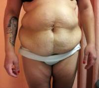 Do you have to lose weight before a tummy tuck operation
