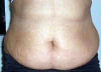 Do you have to lose weight before a tummy tuck surgery