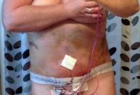 Drainage after tummy tuck drain tubes