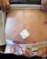 Drains after tummy tuck operation