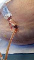 Drains after tummy tuck procedure