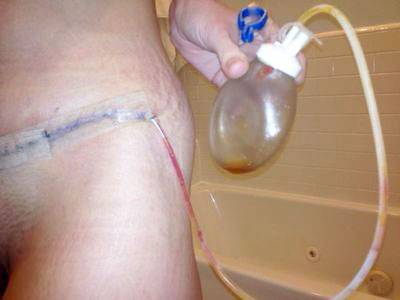 Drains after tummy tuck surgery photo