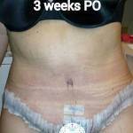 Extended tummy tuck photos after surgery