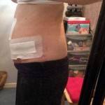 Extended tummy tuck photos recovery