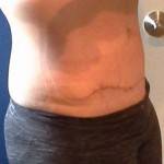Extended tummy tuck photos scar