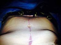 Fleur de lis tummy tuck scar before and after