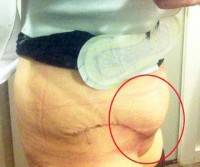Fluid after tummy tuck picture