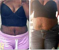 Full tummy tuck abdominoplasty before and after photos