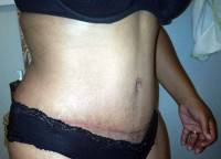 Full tummy tuck operation pictures