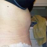 Full tummy tuck pictures after