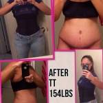 Full tummy tuck pictures after abdominoplasty