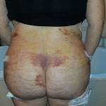 Full tummy tuck pictures and photos
