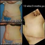 Full tummy tuck pictures before and after