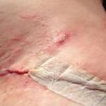 Full tummy tuck pictures scar