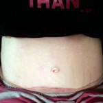 Full tummy tuck pictures stretch marks