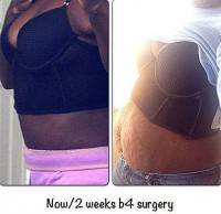 Full tummy tuck procedure before and after photos