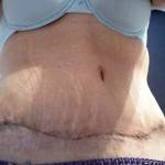 Full tummy tuck surgery pictures