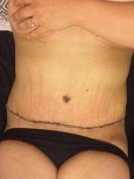 Great tummy tuck results image