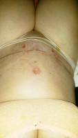 Great tummy tuck results picture