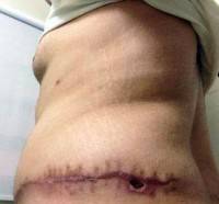How big is a tummy tuck scar image