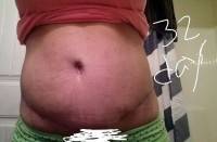 How long is a tummy tuck surgery photo