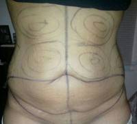 Hysterectomy with tummy tuck surgery