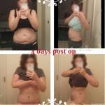 Image an picture tummy tuck and lipo before and after