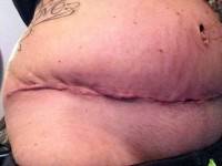 Keloid tummy tuck scar photo