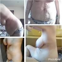 Life after a tummy tuck image