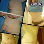Lipo and tummy tuck before and after photos 15 weeks po