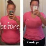 Lipo and tummy tuck before and after photos 2 weeks po
