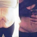 Lipo and tummy tuck before and after photos big belly