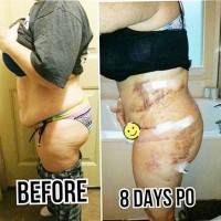 Lipo and tummy tuck before and after photos gallery
