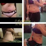 Lipo and tummy tuck before and after photos images